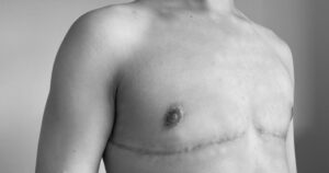 MASTECTOMIA MASCULINIZADORA: a imagem mostra o peito de um homem trans