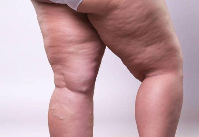 Lipedema: a imagem mostra a parte posterior das pernas de uma mulher com acúmulo de gordura