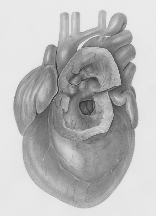 Bioprótese valvular cardíaca pulmonar Kyros tem que ser coberta pelo plano de saúde
